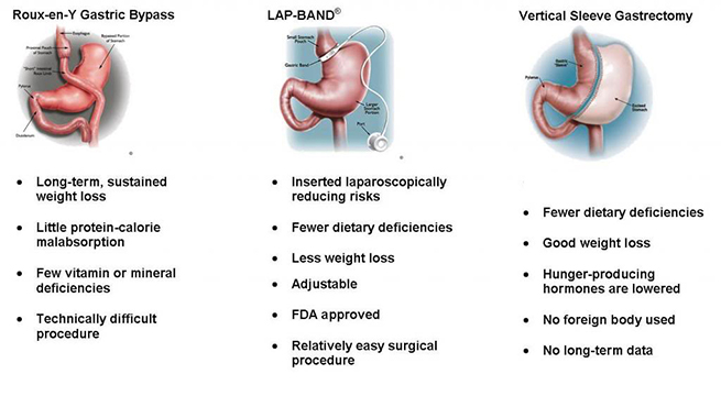 Gastric Bypass Florida Lap Band Tampa Vertical Sleeve