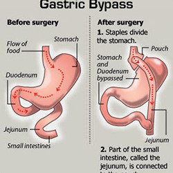 Bariatric Surgery (Lap Band, Gastric Bypass) Helps With Long Term ...