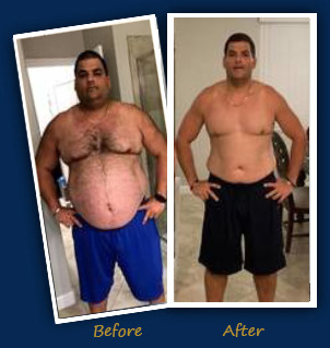 gastric bypass before and after pictures men